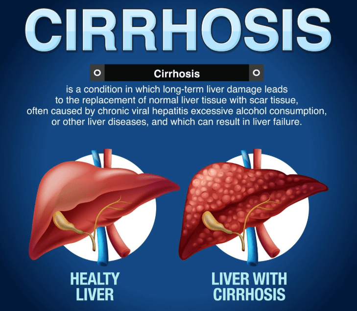 Cirrhosis article cover